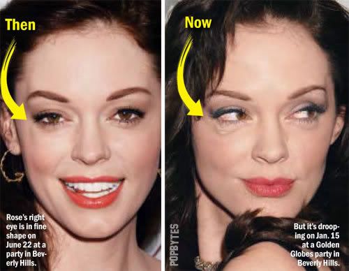  plastic surgery as a result of her droopy eye(s) at the Golden Globes.