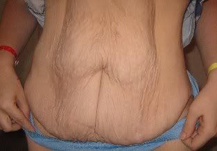 Tummytuck.jpg picture by jillybeanmike